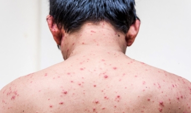 Amerikada meymunçiçəyi təlaşı: insanlar xəstəxanalara axın edirlər